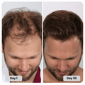 SelfRestored Infrared Hair Growth Therapy Cap